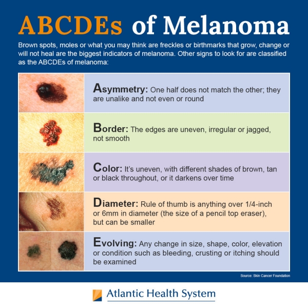 How Can I Recognize Melanoma Warning Signs On My Skin?